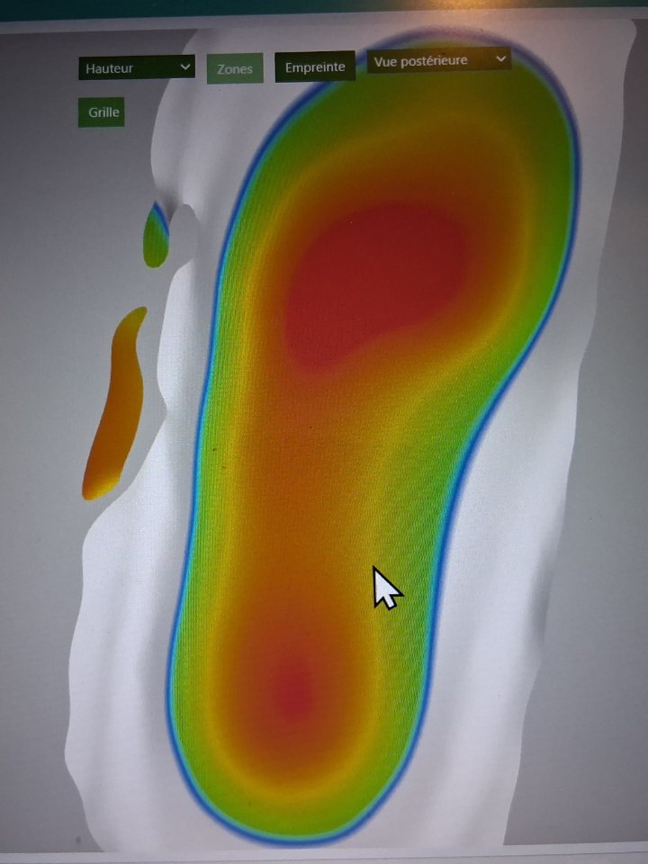 L'empreinte d'un pied relevée par le scanner, affichée à l'écran en carte de chaleur : les zones de forte pression en rouge, celles de faible pression en vert et bleu.