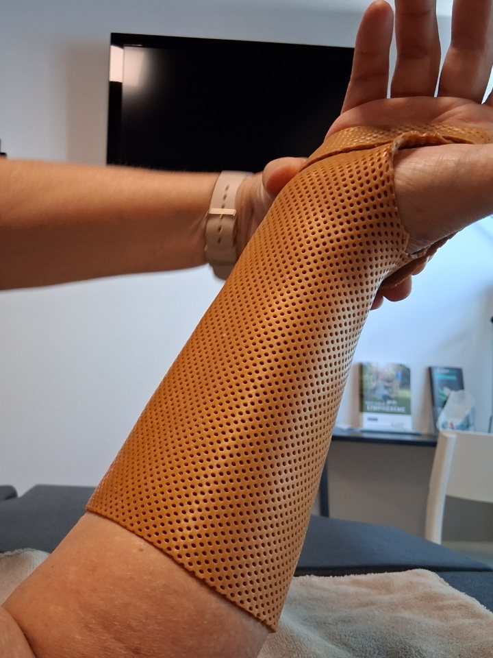 Une orthèse thermoformée de poignet et de main, en thermoplastique orange perforé, moulée sur l'avant-bras d'une personne.