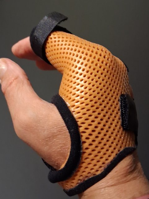 Orthèse thermoformée orange et perforée qui maintient la base du pouce et le poignet, sur la main d'une adulte.