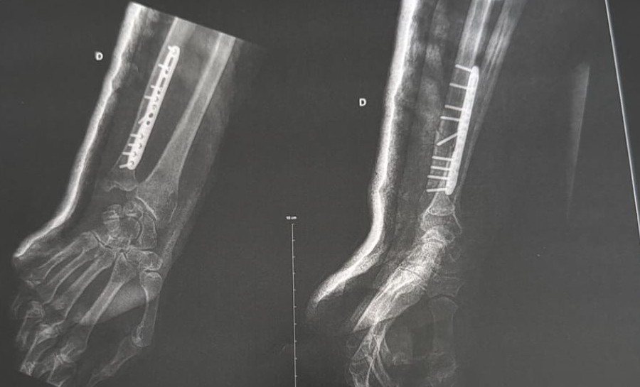 Radiographie d'un poignet opéré, de face et de profil : une plaque et des vis maintiennent l'os.